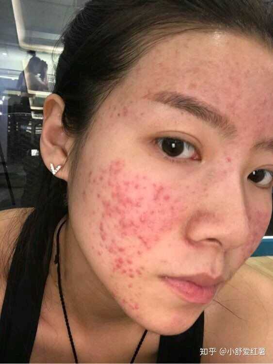 如何有效去除臉上的痘印——全方位指南，全方位指南，如何有效去除臉上痘印的方法