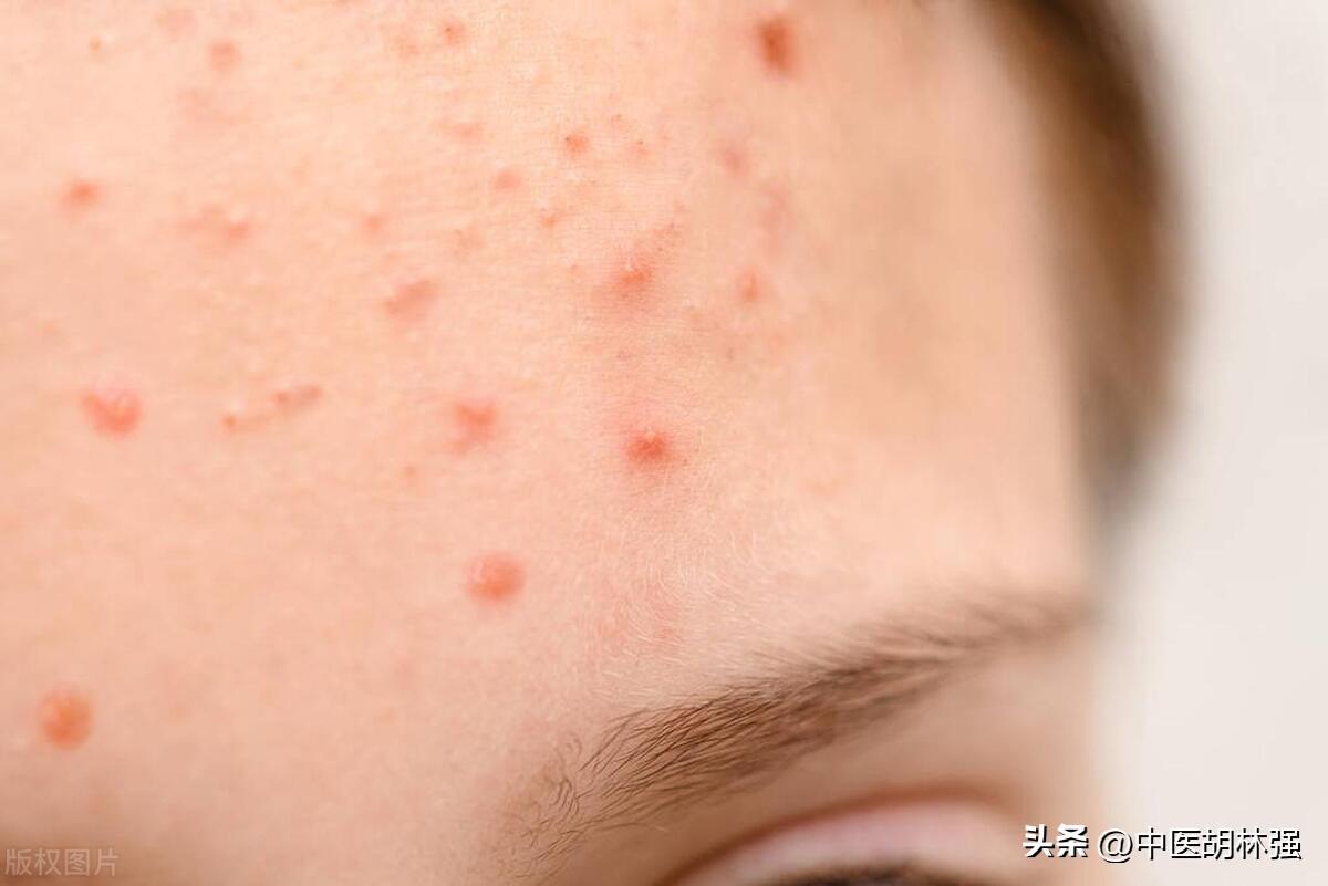 喉嚨發(fā)炎如何快速消炎——全方位指南，喉嚨發(fā)炎全方位快速消炎指南