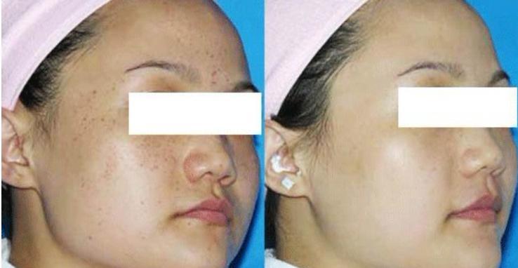 激光祛斑后需要注意的五大事項，激光祛斑后的五大注意事項詳解