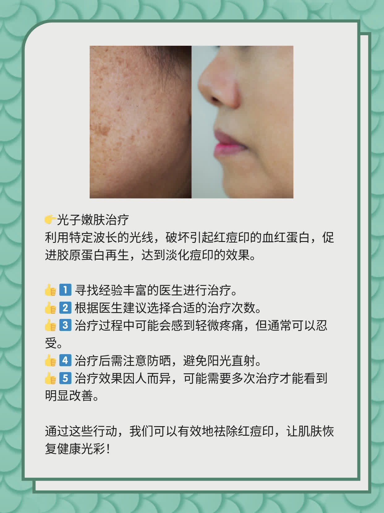 如何有效去除紅痘印，一站式解決方案，一站式解決紅痘印問題，有效去除方法大全