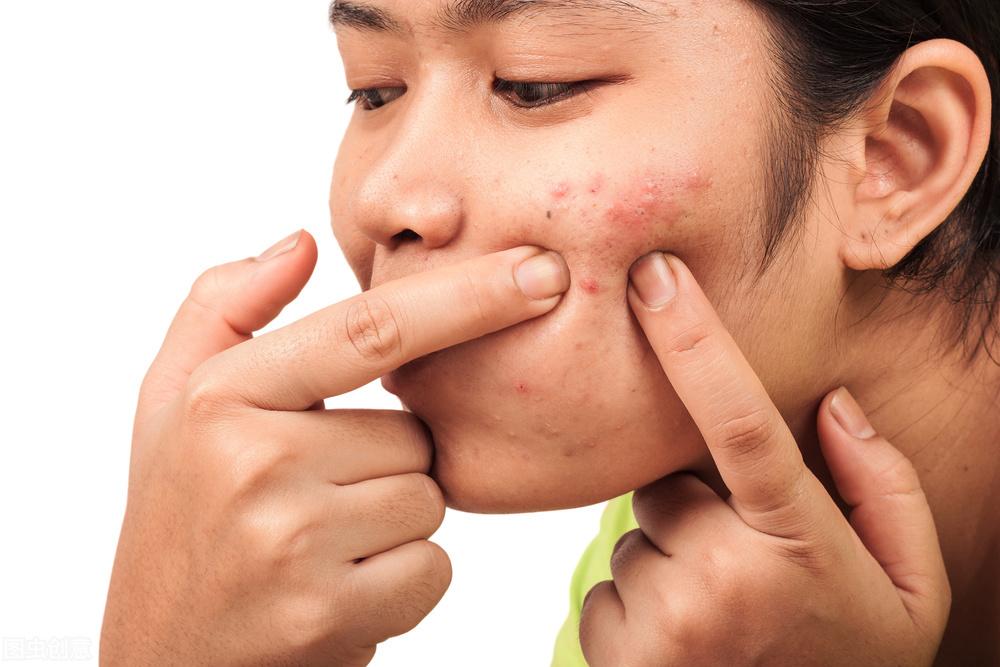 全面解析，痤瘡怎么治才能好？，全面解析，痤瘡治療的有效方法與策略