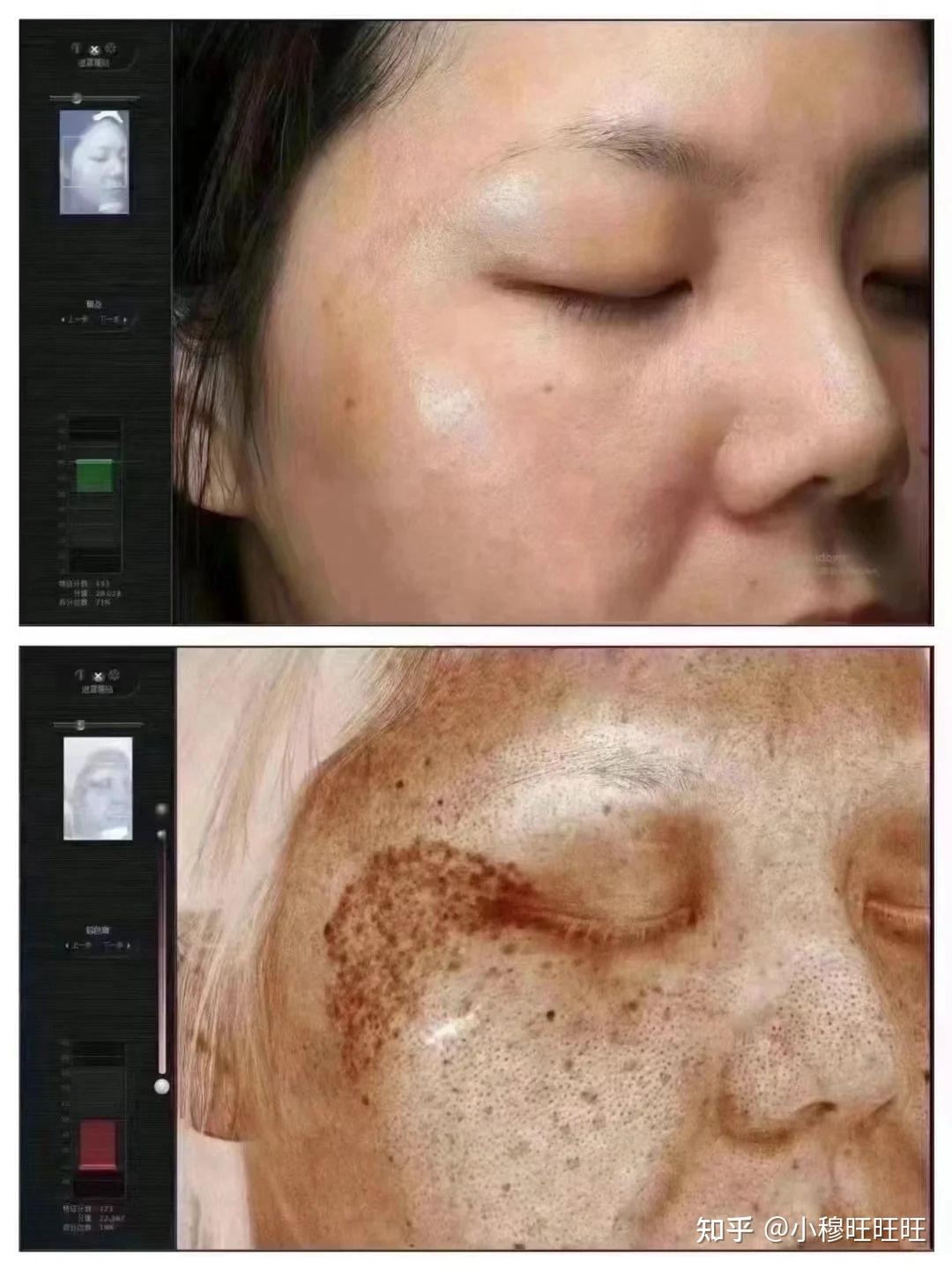 激光祛斑，選擇醫(yī)院還是美容院？全面解讀助您做出明智決策，激光祛斑，如何選擇醫(yī)院與美容院？全面解讀為您指明決策方向