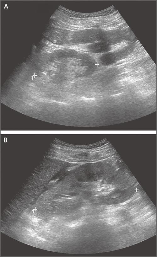 闌尾炎最佳治療方法，闌尾炎最佳治療方法詳解