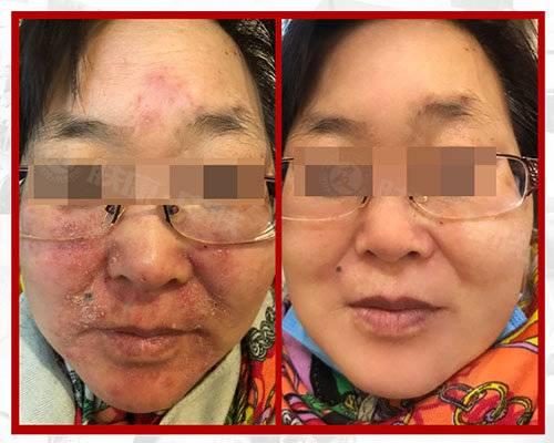 臉部過(guò)敏如何迅速消除，全面指南，臉部過(guò)敏迅速消除全面指南