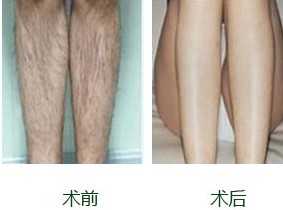 激光脫毛，價格因素詳解，激光脫毛詳解，價格因素剖析