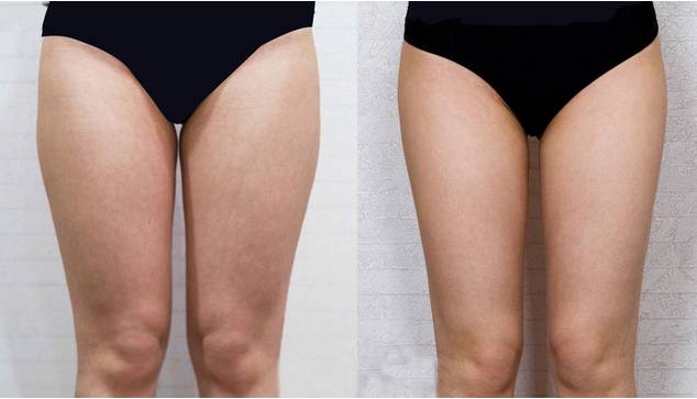 抽脂減肥反彈現(xiàn)象，原因與應(yīng)對策略，抽脂減肥反彈原因及應(yīng)對策略解析