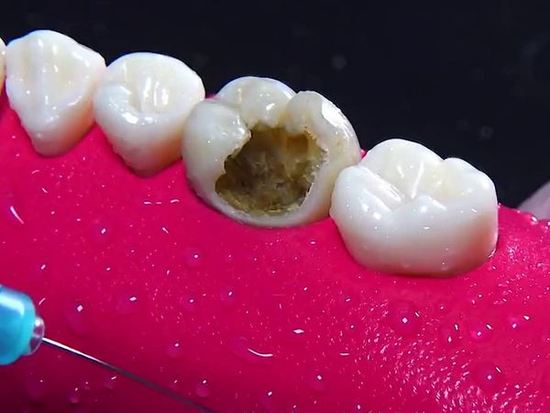 牙齒疼痛，如何應(yīng)對(duì)牙爛大窟窿帶來的困擾，牙齒爛大窟窿引發(fā)疼痛，應(yīng)對(duì)方法解析