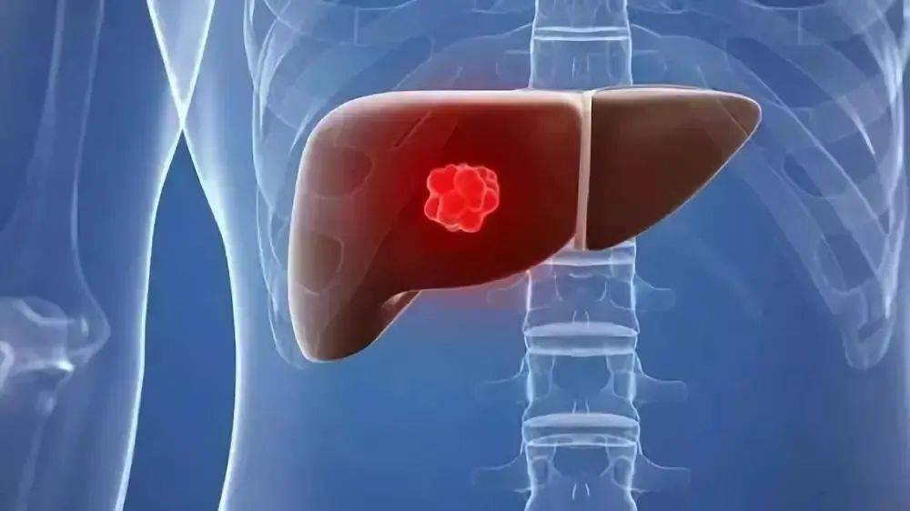 肝癌晚期最怕的三個(gè)征兆，肝癌晚期需警惕的三個(gè)征兆
