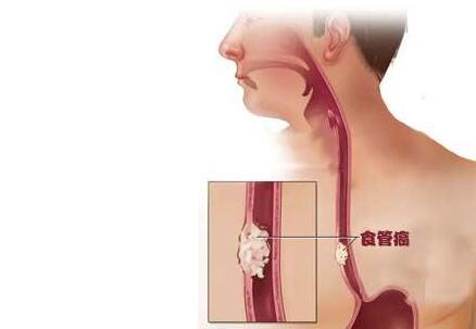 食道癌最明顯的癥狀及其影響，食道癌最明顯的癥狀及其潛在影響