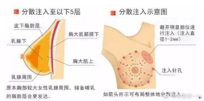 豐胸手術(shù)對(duì)身體的影響，全面解析風(fēng)險(xiǎn)與后果，豐胸手術(shù)風(fēng)險(xiǎn)與后果全面解析，對(duì)身體的影響探討