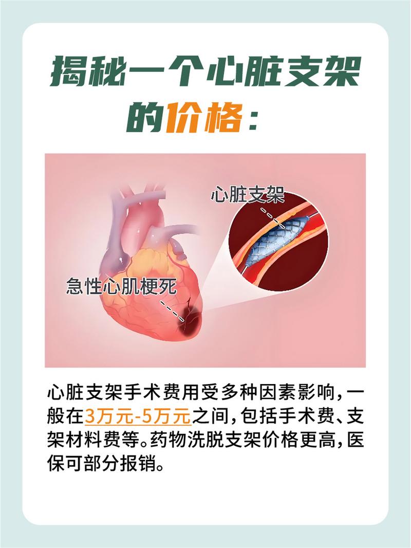 關(guān)于血管支架的價格，你需要知道的一切，血管支架價格全解析，你需要了解的一切