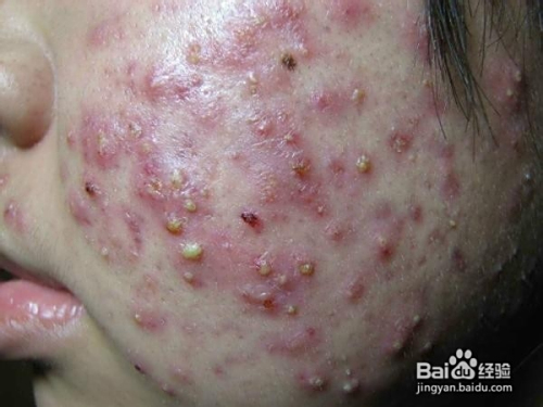 青春痘怎么解決，全方位預(yù)防與治療策略，全方位解決青春痘，預(yù)防與治療策略