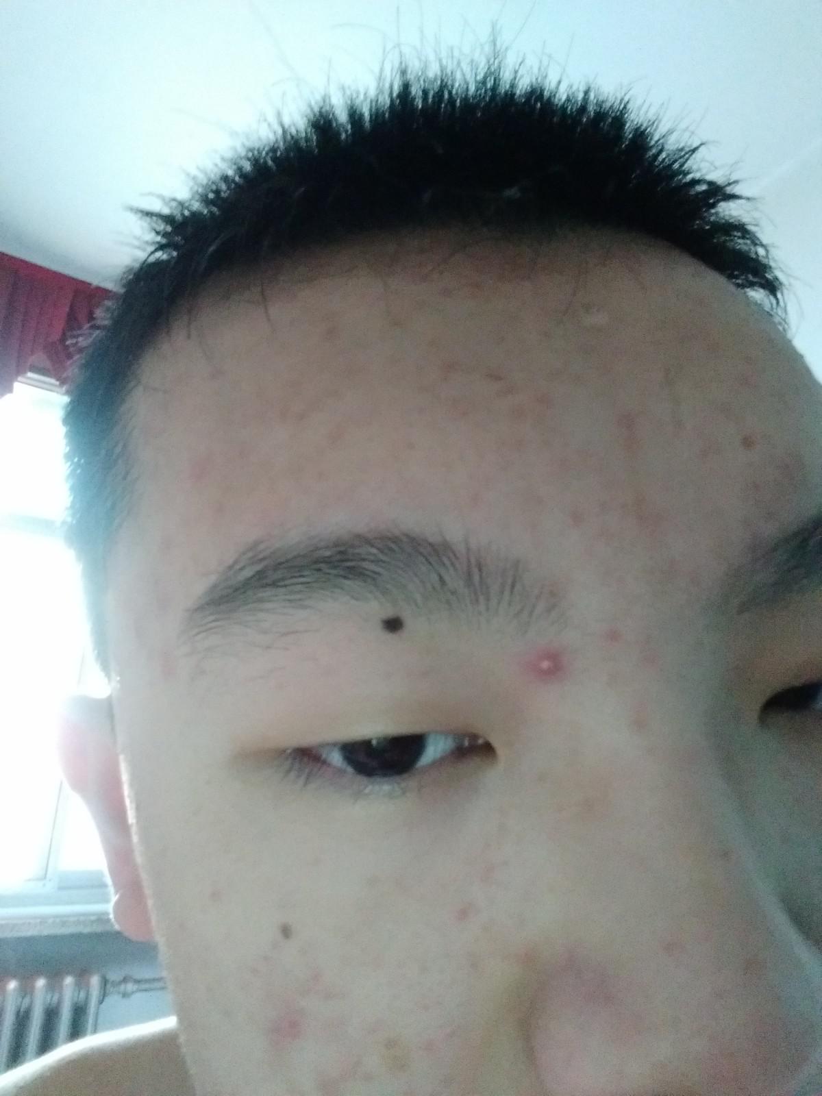 臉上痘痘太多了怎么辦？全方位護(hù)膚指南助你擺脫困擾，全方位護(hù)膚指南，解決臉部痘痘困擾，重拾肌膚光彩