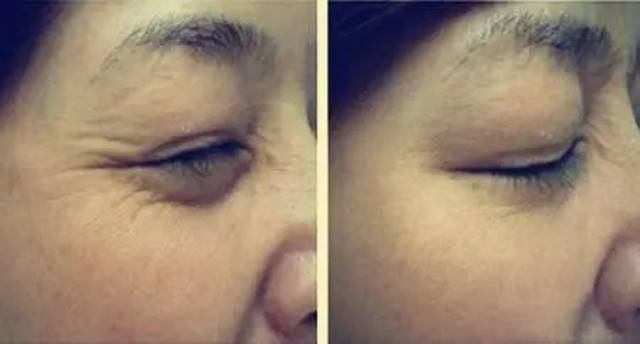 肉毒素除皺的副作用深度解析，肉毒素除皺副作用深度解析