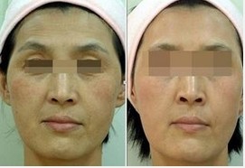 面部除皺針，價格因素與選擇指南，面部除皺針，價格因素與選擇指南詳解