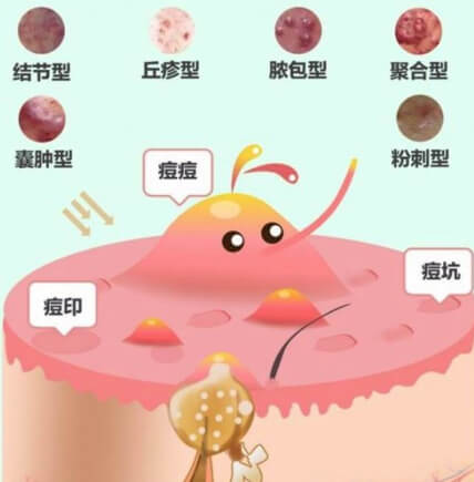 痤瘡忌口食物清單，戰(zhàn)勝痘痘，從飲食開(kāi)始，戰(zhàn)勝痘痘，痤瘡忌口食物清單助你調(diào)整飲食，遠(yuǎn)離皮膚困擾