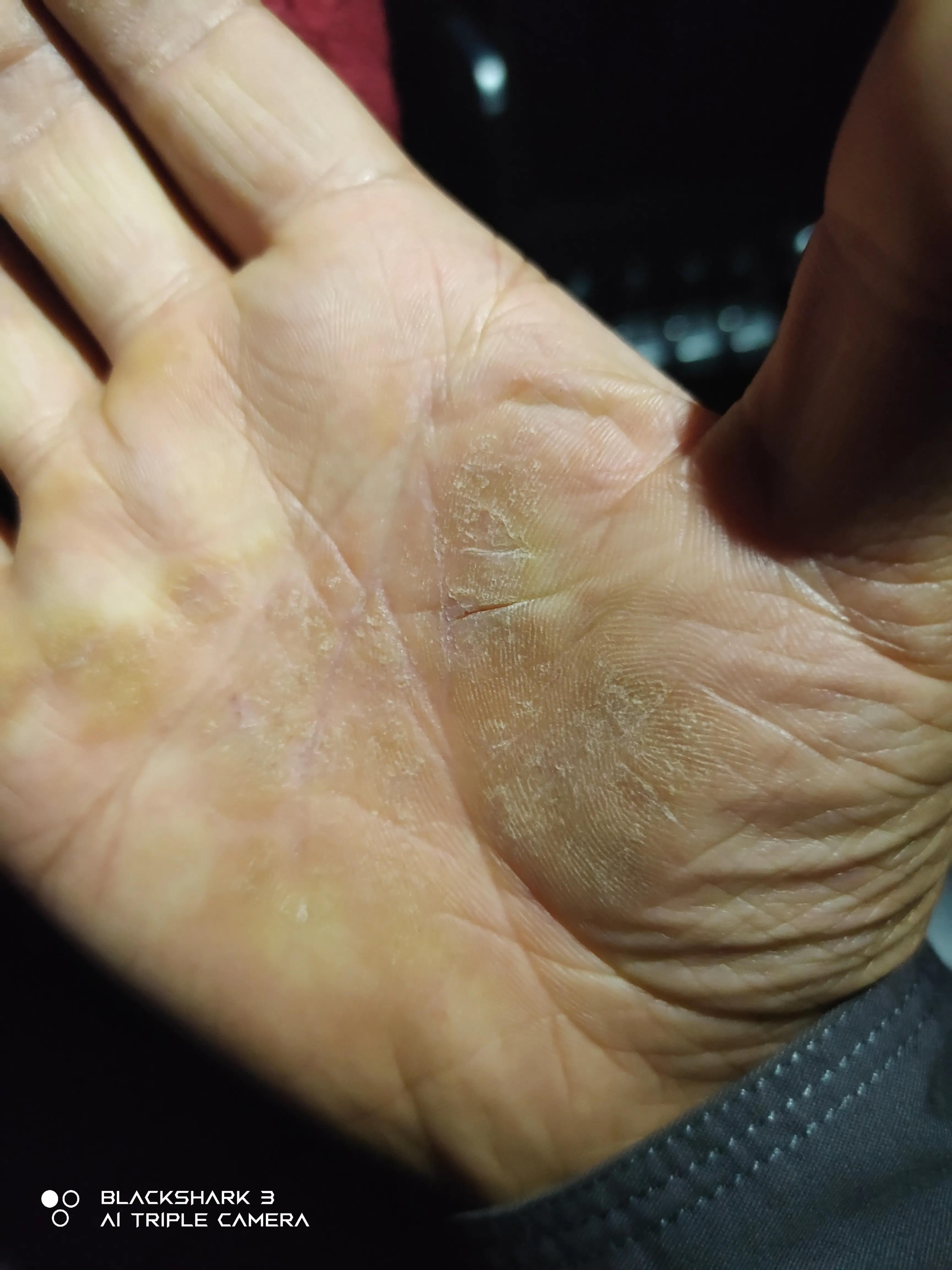 神經(jīng)性皮炎的根治之道，深入了解與有效治療，神經(jīng)性皮炎的根治之道，深入了解與有效治療策略