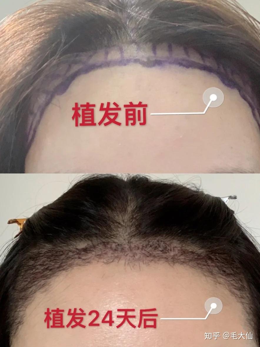 關(guān)于發(fā)際線植發(fā)的費用，你需要知道的一切，發(fā)際線植發(fā)費用全解析