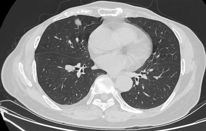 肺結(jié)節(jié)最佳治療方法，全面解析與你的健康之路，肺結(jié)節(jié)最佳治療方法詳解，為您的健康之路指引方向