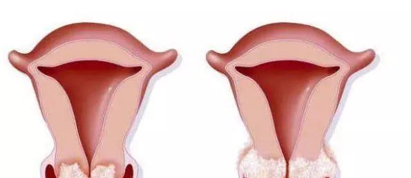 女性HPV初期感染的圖片及其相關(guān)知識(shí)科普，女性HPV初期感染圖片與知識(shí)科普，了解、預(yù)防與治療