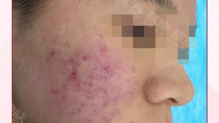 治療痤瘡的費用分析，了解花費多少以及背后的因素，治療痤瘡的費用詳解，了解花費背后的因素