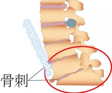 骨刺的最佳治療方法，骨刺的最佳治療方法解析