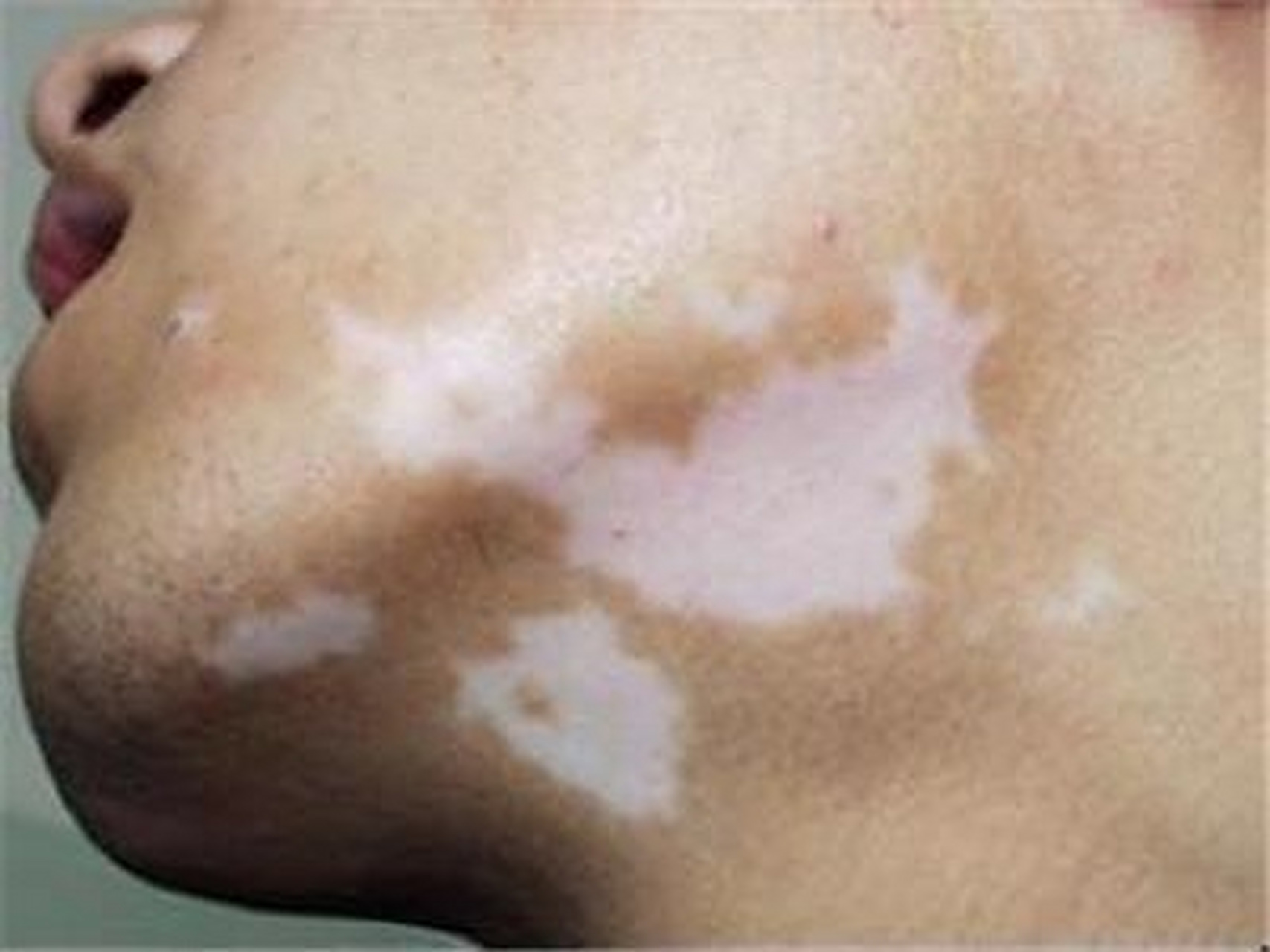 白點癲風怎么治療效果最好，全面解析最佳治療方案，全面解析白點癲風最佳治療方案，治療效果最大化